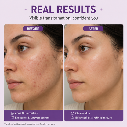 Acmica Acne Face Serum