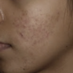 Acmica Acne Face Serum photo review