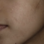 Acmica Acne Face Serum photo review