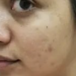 Acmica Acne Face Serum photo review