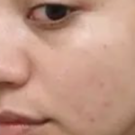 Acmica Acne Face Serum photo review