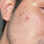 Acmica Acne Face Serum photo review