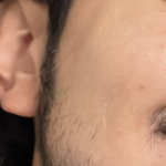 Acmica Acne Face Serum photo review