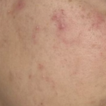 Acmica Acne Face Serum photo review