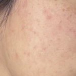 Acmica Acne Face Serum photo review