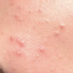 Acmica Acne Face Serum photo review