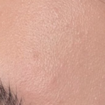 Acmica Acne Face Serum photo review