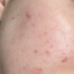 Acmica Acne Face Serum photo review