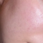 Acmica Acne Face Serum photo review