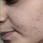 Acmica Acne Face Serum photo review