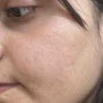 Acmica Acne Face Serum photo review